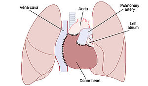 Schematic of a transplanted heart with native ...