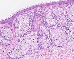 Multiples glandes sébacés volumineuses réalisant une hyperplasie sébacée.