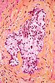 Frustolo bioptico, colorazione cromo-ematossilina-floxina, altro esempio di invasione perineurale da parte di gruppi ghiandolari neoplastici.