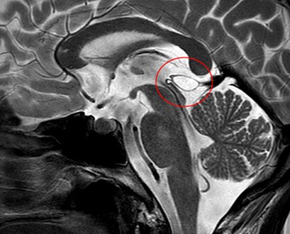 Another case: sagittal