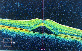 Возникновение центральной серозной ретинопатии в центральной ямке показанное с помощью оптической когерентной томографии.