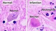 Histopathology at high magnification of a normal neuron, and ischemic stroke at approximately 24 hours on H&E stain: The neurons become hypereosinophilic and there is an infiltrate of neutrophils. There is slight edema and loss of normal architecture in the surrounding neuropil. Histopathology of thalamus infarction at approximately 24 hours, high magnification, annotated.jpg