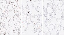 Presence of Sars-CoV-2 virus RNA in the lung. Covid-19 lung showed virus replication in the desquamated lung epithelial cells. Ubiquitin C positive control (Left), COVSPIKE (middle), and dap B negative control (right). Presence of Sars-CoV-2 virus RNA in the lung.jpg