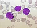Sangue periférico de uma criança com leucemia linfoide aguda, coloração Pappenheim, magnificação x100