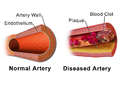 Illustration Comparing Normal Artery vs Diseased Artery with a Blood Clot