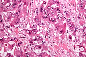 Fibrolamelární hepatocelulární karcinom -2- velmi vysoký mag.jpg