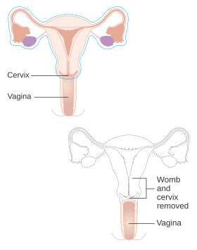 Диаграма, показваща части от тялото, отстранени с радикална хистеректомия CRUK 180.svg