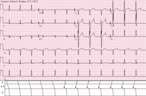 NSR-atrial fusion-AJR-shift-pacemaker.png