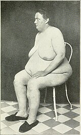 Обнаженная женщина с липоматозным синдромом Фрелиха.jpg