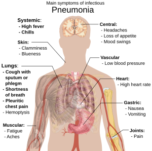 Illustration of pneumonia symptoms on a human body