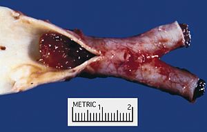 Atrial myxoma embolus.jpg