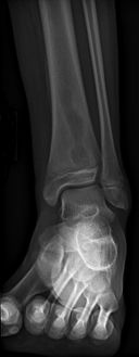 Periostial reaction along the medial cortex indicates an aggressive lesion. Neoplasm such as Ewing sarcoma and osteomyelitis could both have this plain radiographic appearance. Staphylococcus was recovered at surgery.