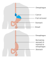 Illustrazione che mostra il prima e dopo di un intervento di esofagectomia