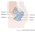 Diagram showing the area removed with a posterior surgery