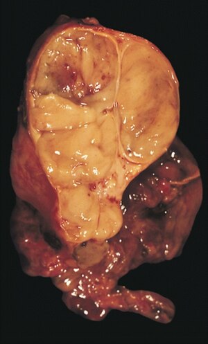 Encapsulated thymoma.jpg