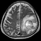 Granulomatous amoebic encephalitis