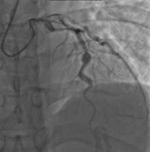 Angiography showing ectatic LAD, with largest aneurysm = 6.5 mm in diameter KawasAngio.png