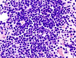 Multiple myeloma (2) HE stain.jpg