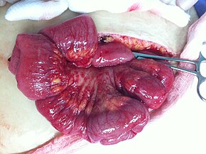 Ovarian adenocarcinoma deposit in the mesentery of the small bowel Tumor deposet.JPG