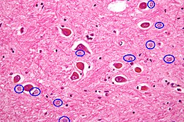 type Alzheimer II astrocytes hilighted.jpg