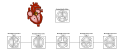 The aortic valve controls outflow of blood from the left ventricle of the heart through the aorta (valve is indicated within the yellow highlighted box). Normal aortic valve is tricuspid. Five types of bicuspid valve are shown, with Type 1 being most prevalent. Bicuspid valve forms when the tissue surrounding one of the cusps (leaflets) of the valve fuse during fetal development. This developmental anomaly can have either negative or no effect on the individual.