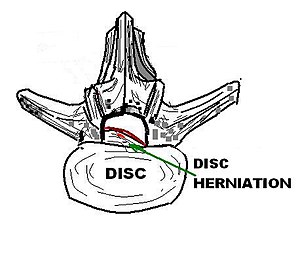 English: Drawing of a disc herniation in the h...
