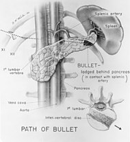 Path of the bullet that wounded Garfield Path of Bullet that wounded President James A. Garfield - Duncan K. Winter drawing - NCP 001860.jpg