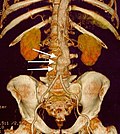 Miniatura per Aneurisma de l'aorta abdominal