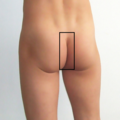 Intergluteal cleft