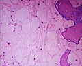 June 31: histopathology slide of chordoma