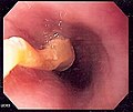 Image of a piece of food obstructing the esophagus