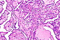 Mesotelioma