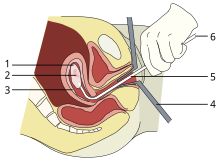 A vacuum aspiration abortion at eight weeks gestational age (six weeks after fertilization).
1: Amniotic sac
2: Embryo
3: Uterine lining
4: Speculum
5: Vacurette
6: Attached to a suction pump Vacuum-aspiration (single).svg