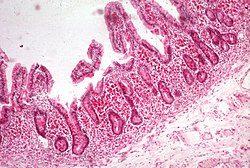Whipplen tauti: Histologinen kuva, josta näkyy suurentuneita nukkalisäkkeitä ja paljon makrofageja