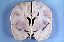 Gehirn bei Alexander-Krankheit. Autopsiefall eines vierjährigen Jungen mit übermäßiger Größe des Gehirns (Makroenzephalie) und periventrikulärer Entmarkung.