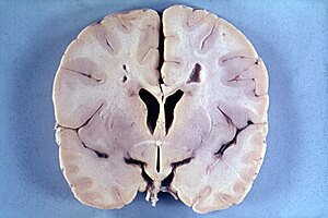 Мозок 4-річного хлопчика з хворобою Вільяма Александера, препарат показує набряк мозку, навколошлуночкову лейкомаляцію (розм'якшування мозку) у вигляді змін коричневого кольору навкруги шлуночків мозку