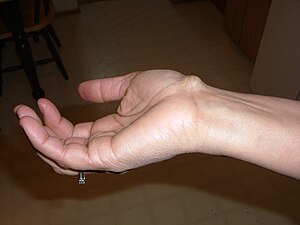 This is a ganglion cyst on the inner right wri...