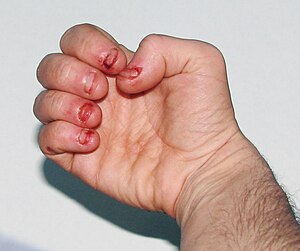 English: Dermatophagia - extreme nail biting /...