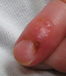 2 on Herpetic Whitlow In A Young Child Who Earlier Had Developed Herpes