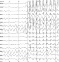 Miniatura para Epilepsia