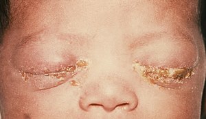 ID#: 3766 This was a newborn with gonococcal o...