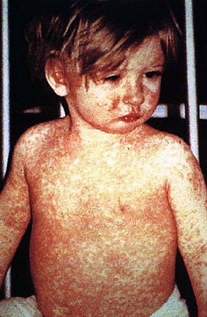 Measles. This child shows a classic day-4 rash...