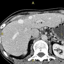 Axial CT image showing anomalous hepatic veins coursing on the liver's subcapsular anterior surface[66]