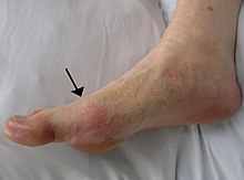 पैर का पार्श्वदृश्य जो अंगूठे के आधार पर जोड़ के ऊपर त्वचा का एक लाल धब्बे दिखाता है