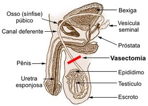 Diagrama sobre a vasectomia. Baseado em Illu r...