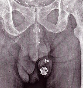 An X-ray image of implanted ZSI 375. The device is deactivated – the spring is compressed below the top of the cylinder. Patient is incontinent.