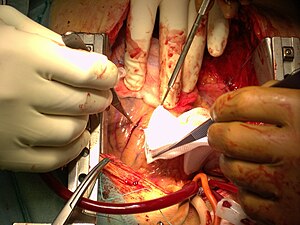Coronary artery bypass surgery, the usage of c...