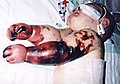 Bőrvérzéses kiütések egy csecsemő végtagjain.
