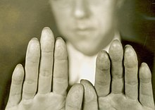 Criminal Alvin Karpis had his fingerprints surgically removed in 1933 Altered Fingerprints of Alvin Karpis.jpg
