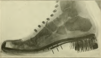 1920 US Marine Corps shoe, with high heel, showing position of foot bones (vertical black marks on the x-ray are nails used to hold the sole and heel on)